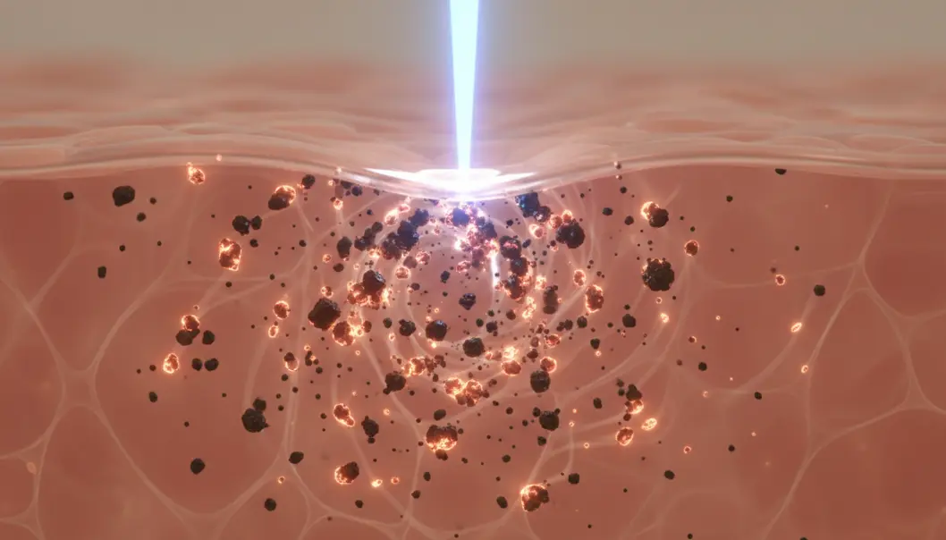 Revlite laser uses rapid pulses of light energy to target and break down skin pigmentation.