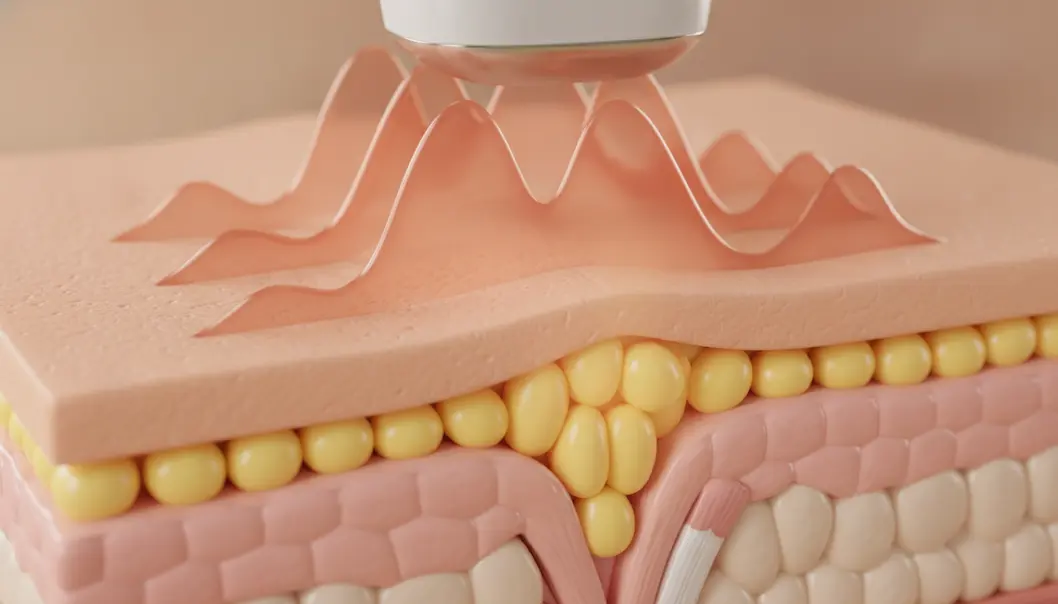 HIFU technology targets deep fat layers while stimulating collagen production.