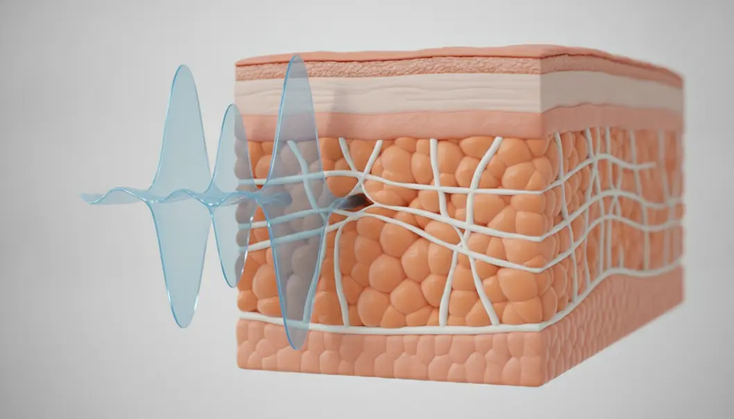 Acoustic waves target fat cells and improve skin elasticity.