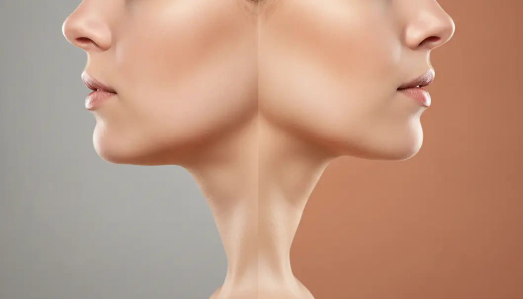 V Shurink primarily targets the lower face to create a defined, youthful V-line contour.
