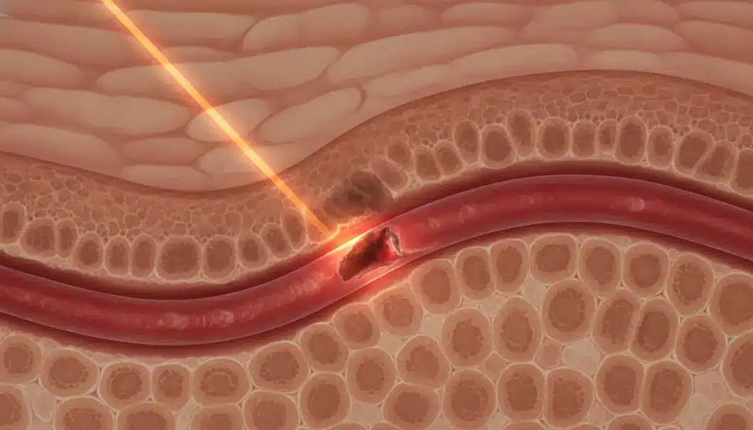 Vascular lasers target the hemoglobin in blood vessels using selective photothermolysis.