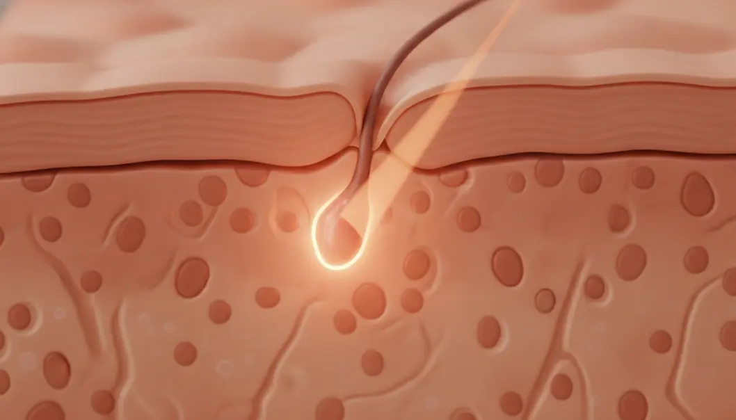 The Neobeam laser’s 1450nm wavelength safely penetrates the skin to target and shrink overactive sebaceous glands.