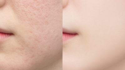 스킨부스터 종류