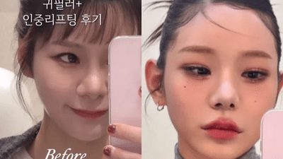 귀필러, 뼈 안 깎고도 얼굴이 작아 보이는 요정귀 디자인의 숨겨진 원리와 부작용 완벽 가이드 4 귀필러, 뼈 안 깎고도 얼굴이 작아 보이는 요정귀 디자인의 숨겨진 원리와 부작용 완벽 가이드