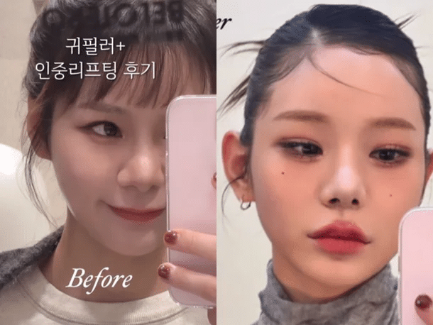 귀필러, 뼈 안 깎고도 얼굴이 작아 보이는 요정귀 디자인의 숨겨진 원리와 부작용 완벽 가이드