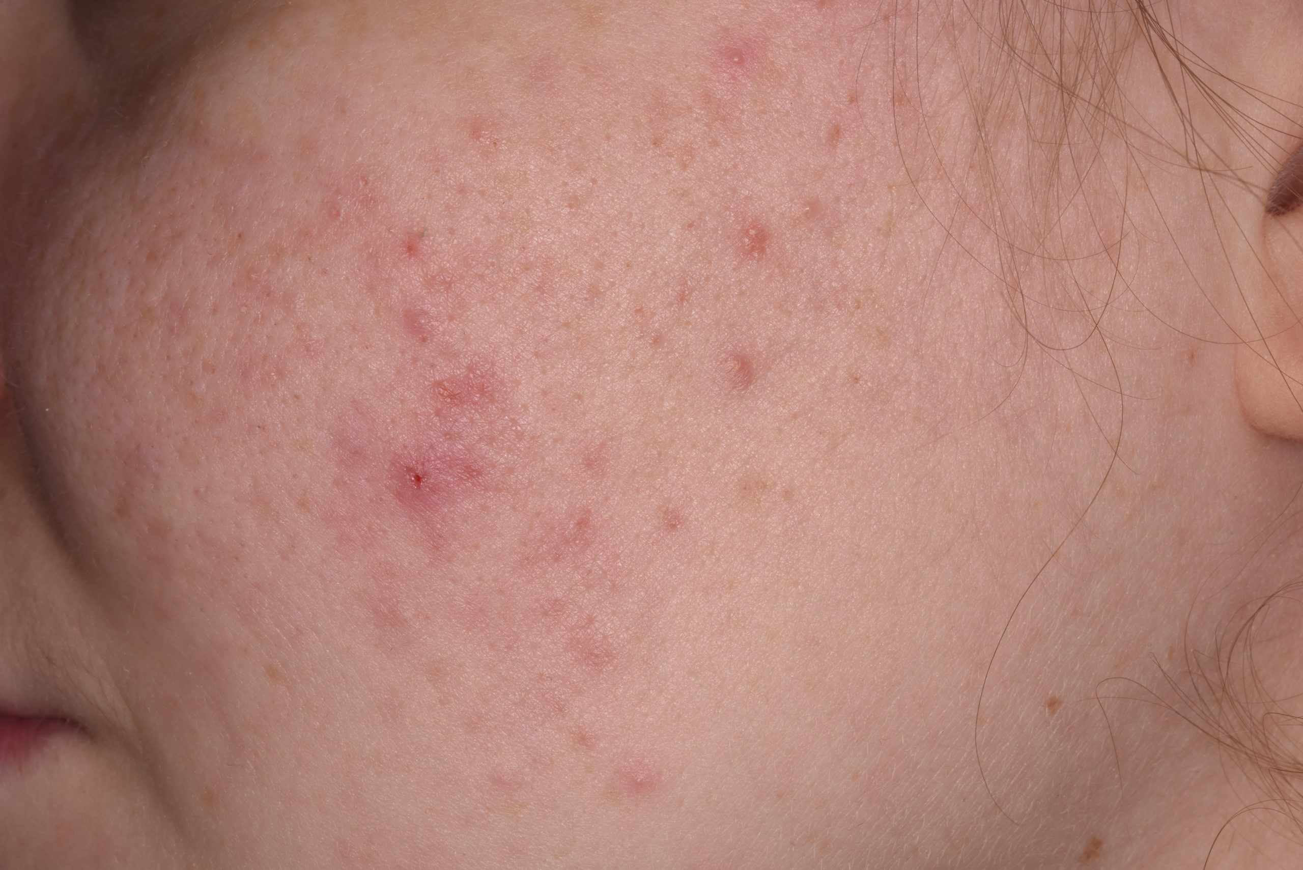 Acne Treatments