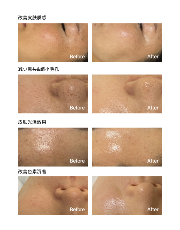 2026醫美趨勢:韓國第四代黑科技XE-LHA PEEL,讓敏感肌也能無痛逆襲「水煮蛋肌」 3 第四代XE LHA PEEL 改善