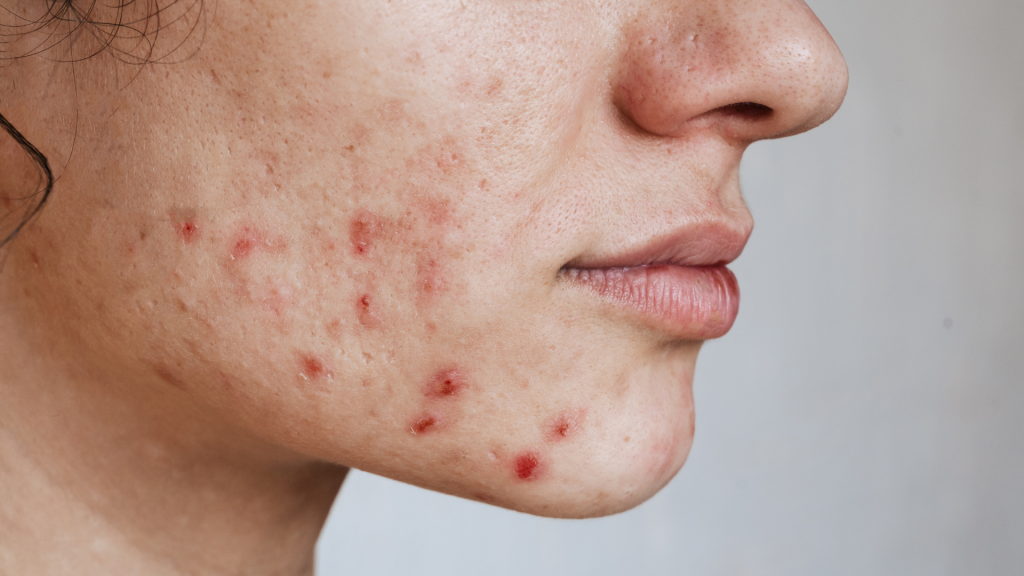 痘痘痤疮管理的关键是?皮脂控制与炎症镇静很重要 3 1痘痘痤疮护理