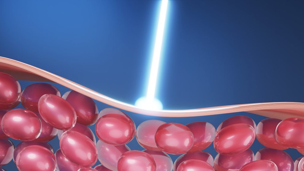 皮秒激光治疗的5大功效:快速改善肤色与色素沉着 3 皮秒激光治疗2