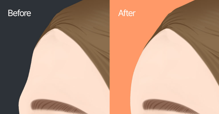 额头凹陷?一针额头填充打造完美立体饱满额头 3 额头填充