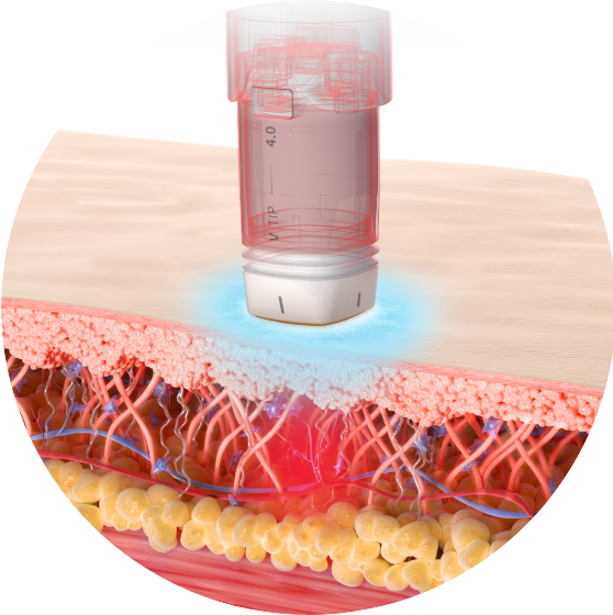 金秀贤代言的新时代Volnewmer提升仪器5大推荐理由 3 Volnewmer提升1