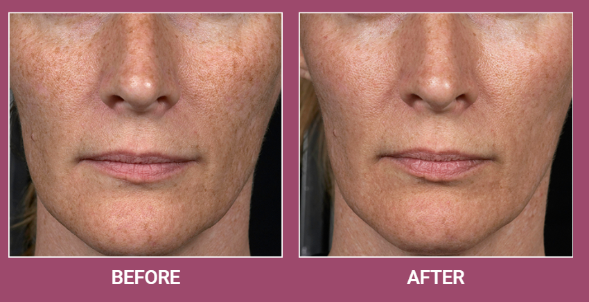 镭射飞梭:全方位修复肌肤,恢复光滑无瑕的秘诀 3 镭射飞梭