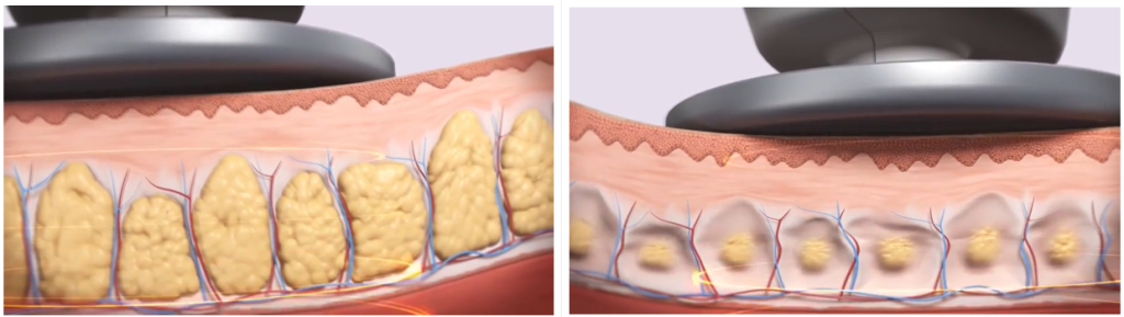韩国提升仪器大盘点:TuneLiner提升是什么? 3 Tune Liner提升1