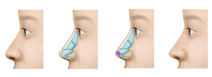 还我妈生鼻!韩国隆鼻修复效果自然,2月后侧脸绝了! 3 隆鼻修复1