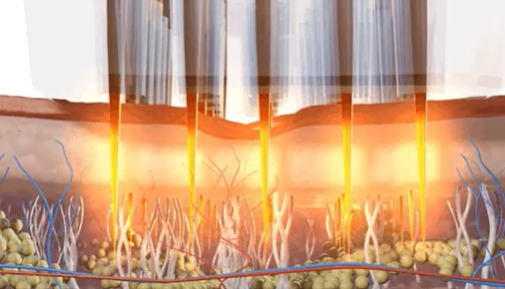 在韓國爲什麼都不推薦韓國的黃金微針?看完這篇皮膚科總結你就懂了! 2 image 6